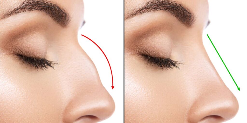 Rhinoplasty